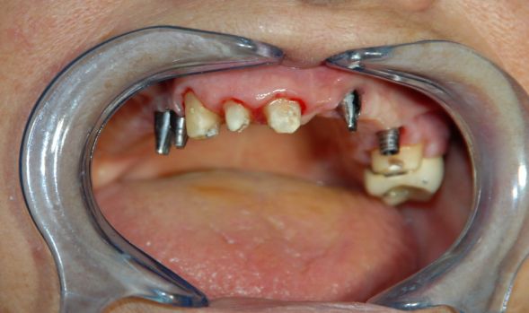 3.2. Filary zębów i implantów